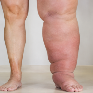 Lymphedema